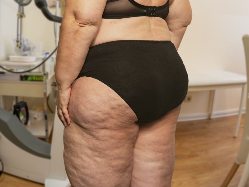 Lipedema_ Alivio e Bem Estar Atraves da Nutricao Especializada