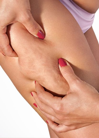 Lipedema em Curitiba